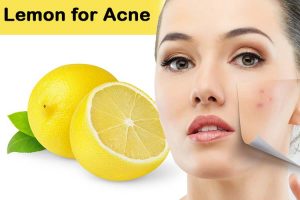 Get Rid Of Acne Scars Quickly With Lemon